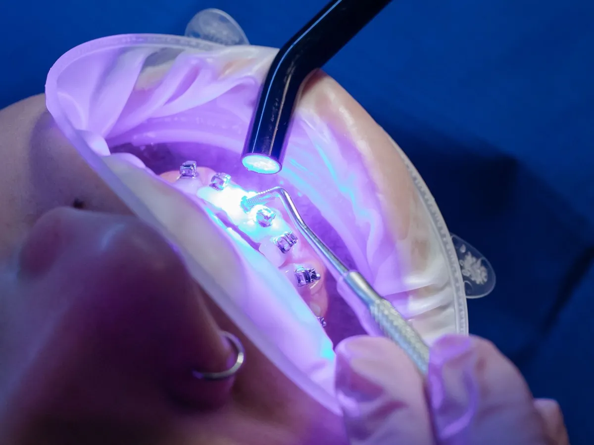 Colocación de brackets en un tratamiento de ortodoncia